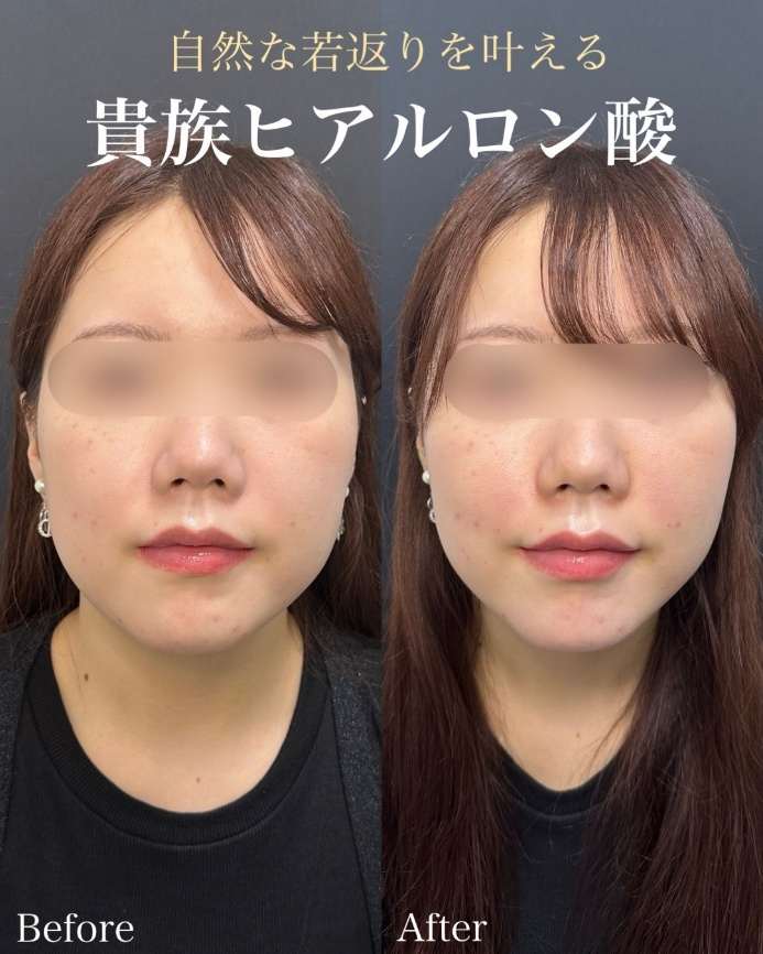ヒアルロン酸の症例写真