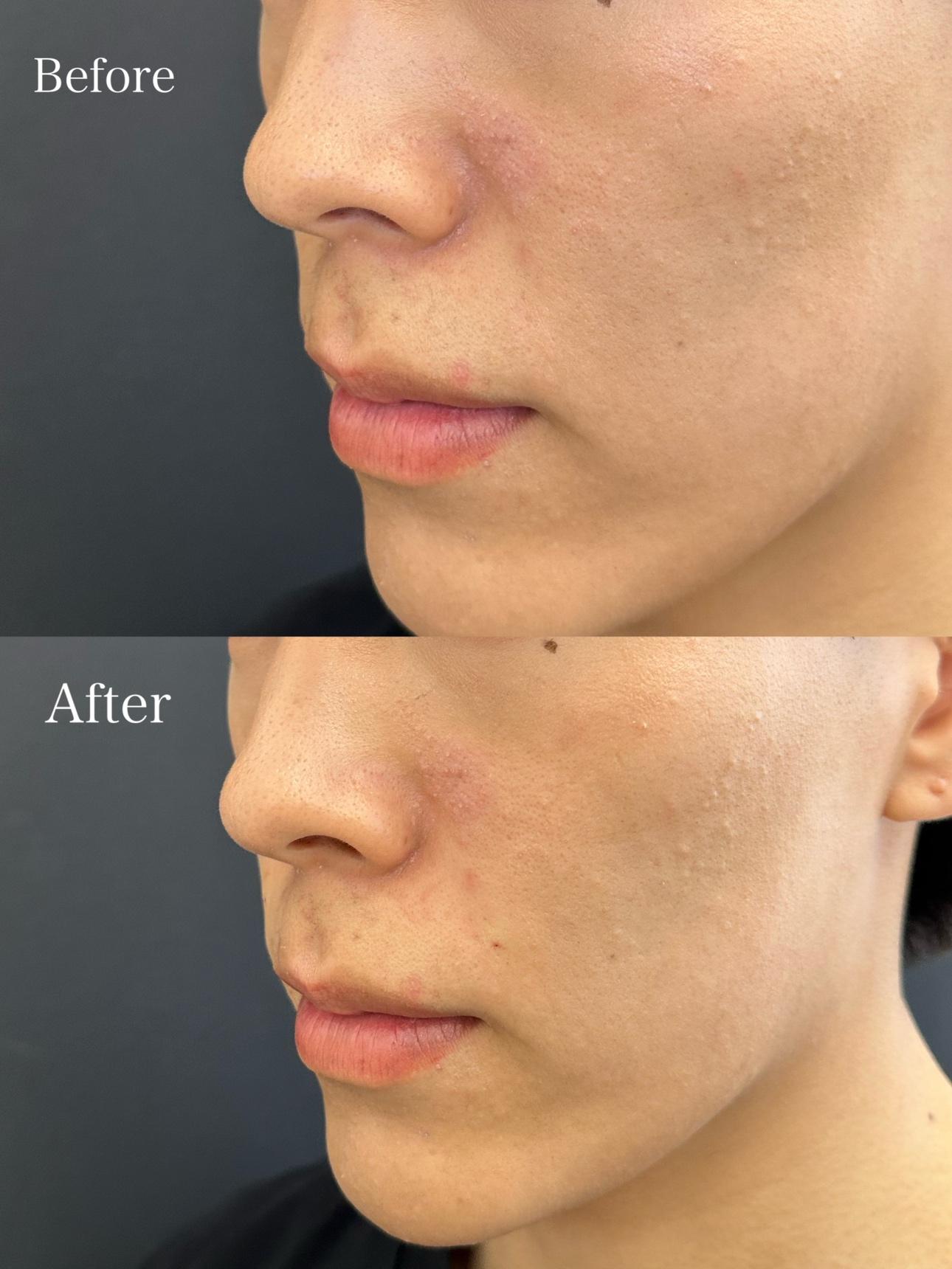 ヒアルロン酸の症例写真