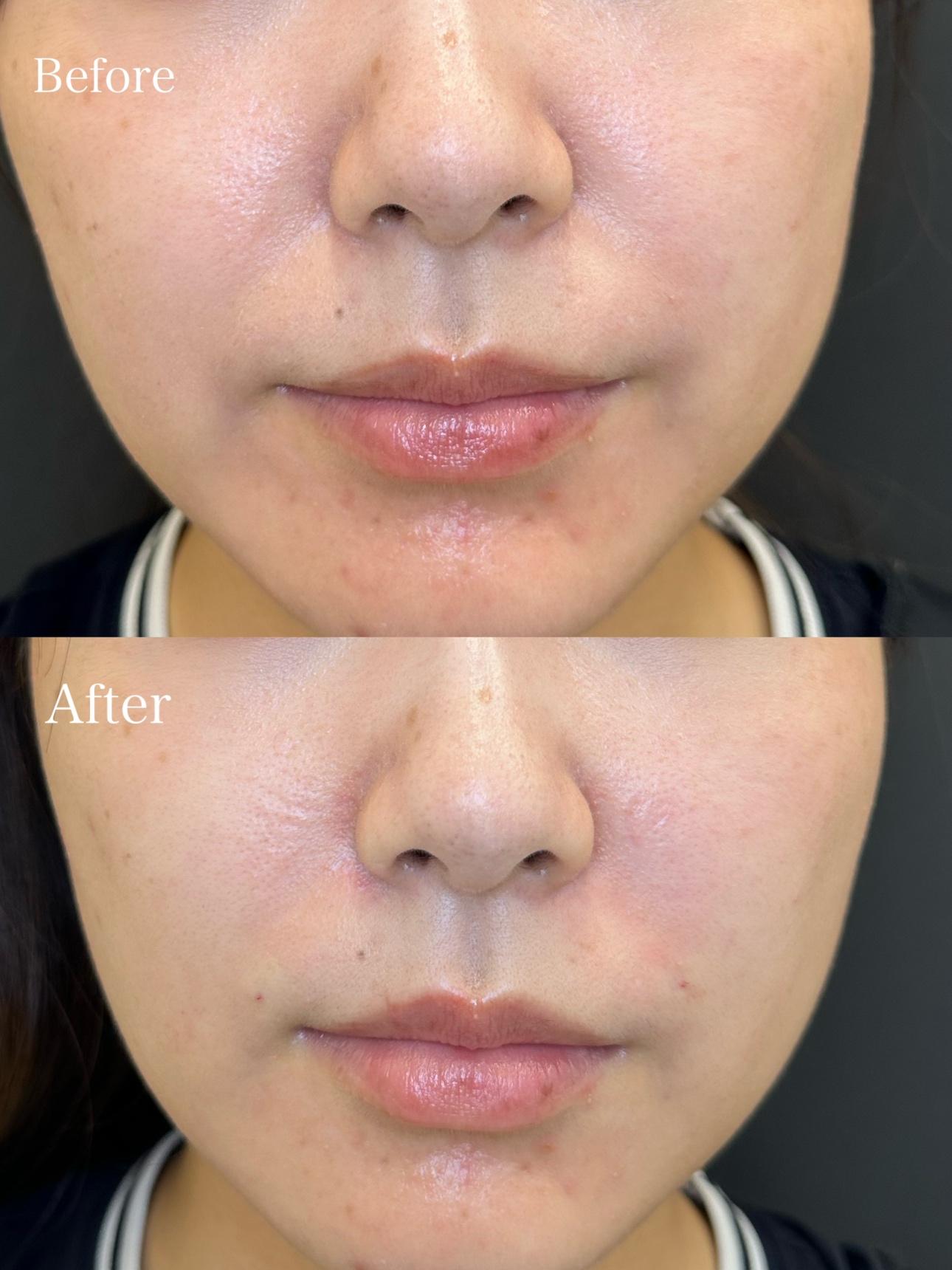 ヒアルロン酸の症例写真