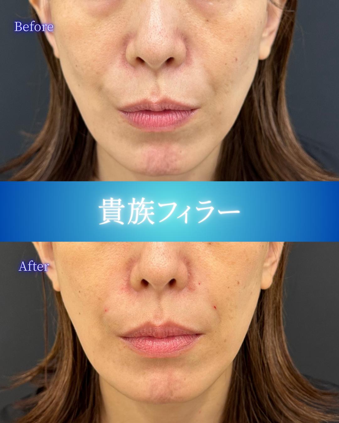 ヒアルロン酸の症例写真