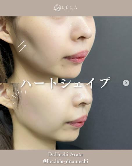 ヒアルロン酸の症例写真