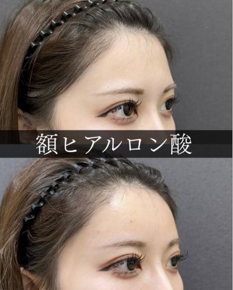 ヒアルロン酸の症例写真
