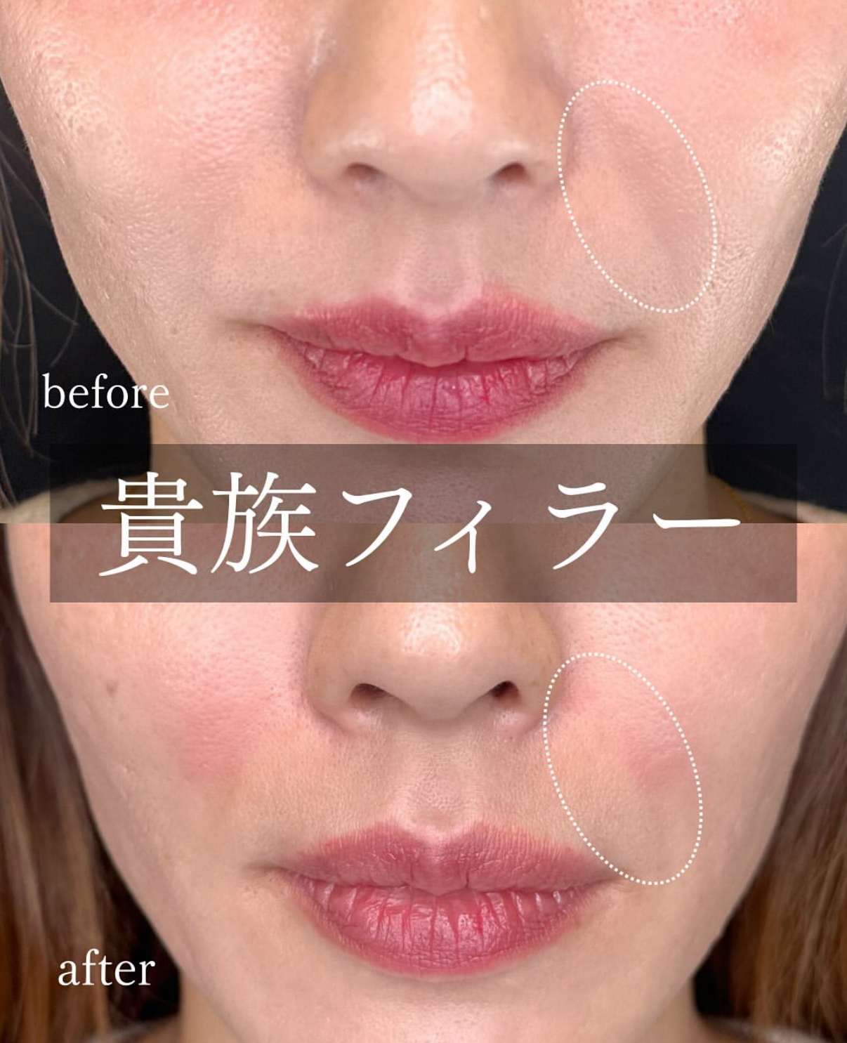 ヒアルロン酸の症例写真