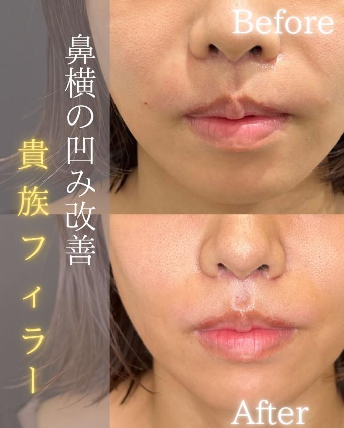 ヒアルロン酸の症例写真