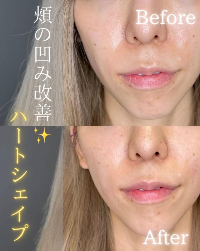 ヒアルロン酸の症例写真