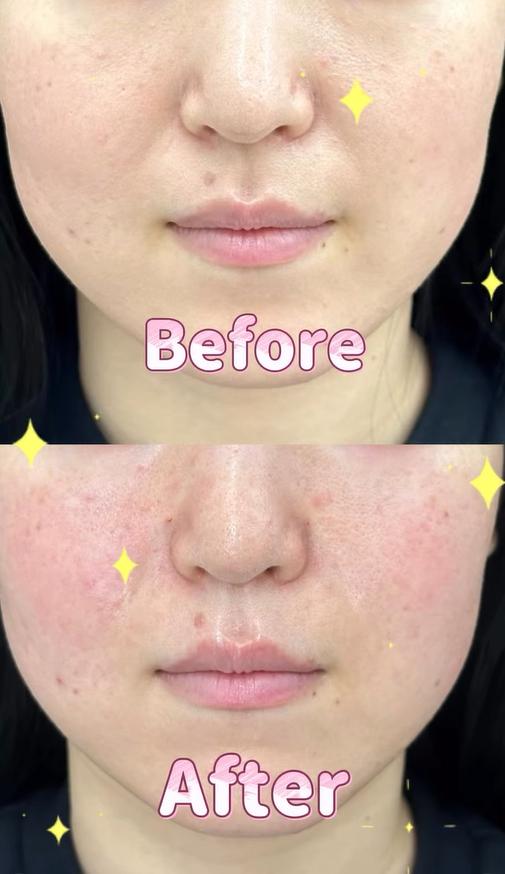 ヒアルロン酸の症例写真