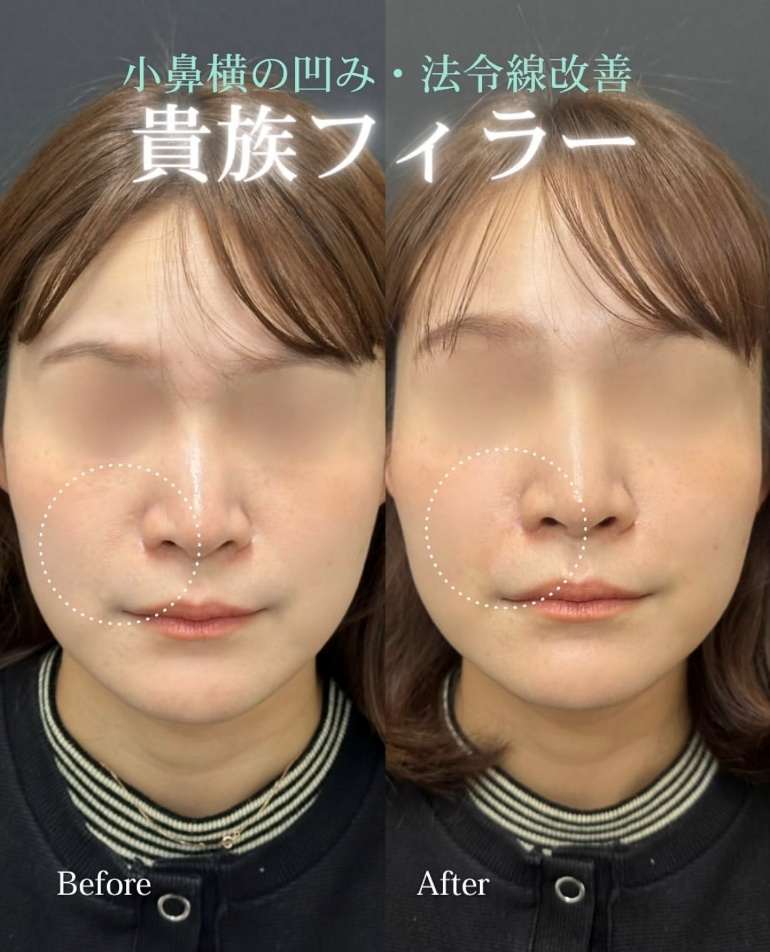 ヒアルロン酸の症例写真