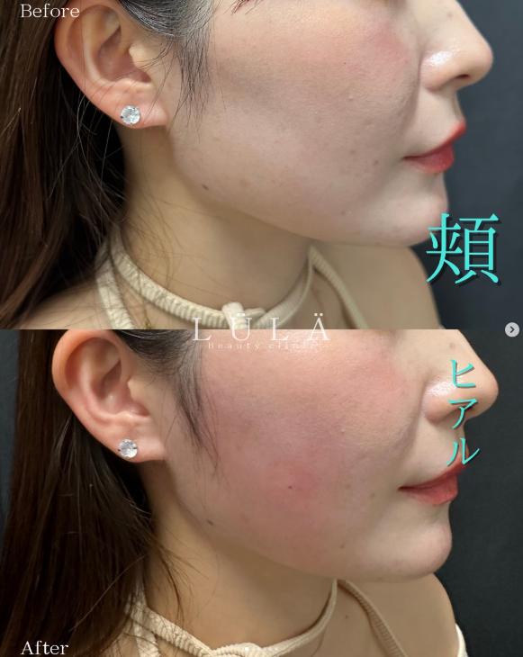 ヒアルロン酸の症例写真