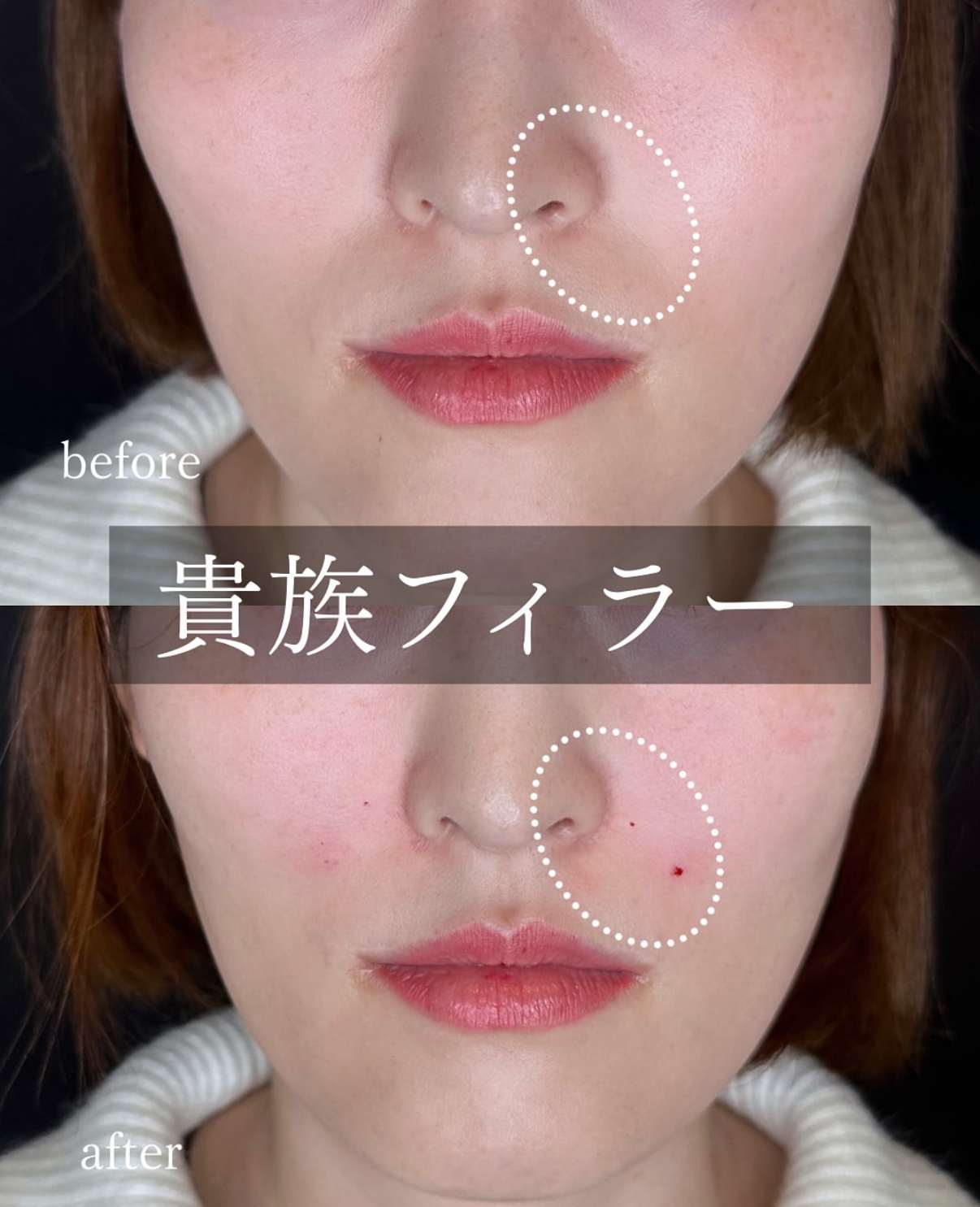 ヒアルロン酸の症例写真