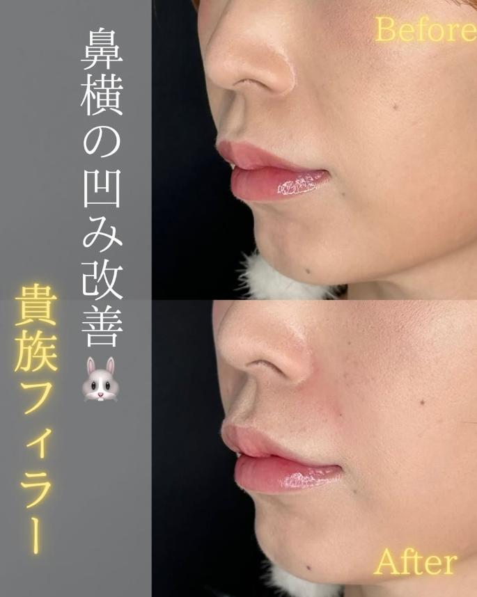 ヒアルロン酸の症例写真