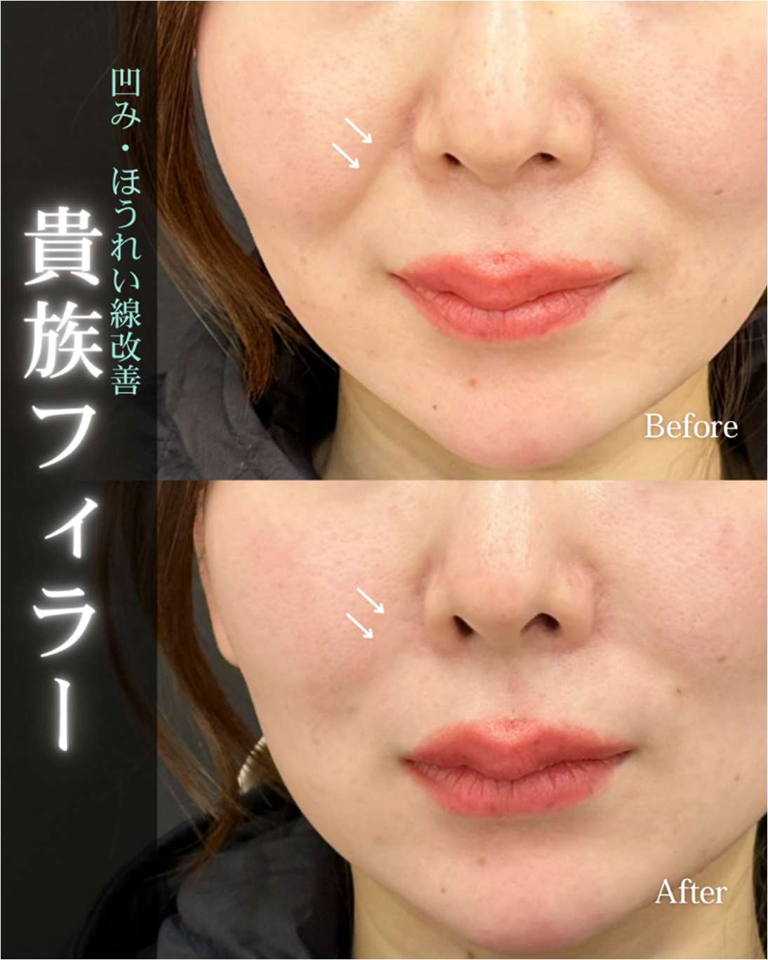 ヒアルロン酸の症例写真