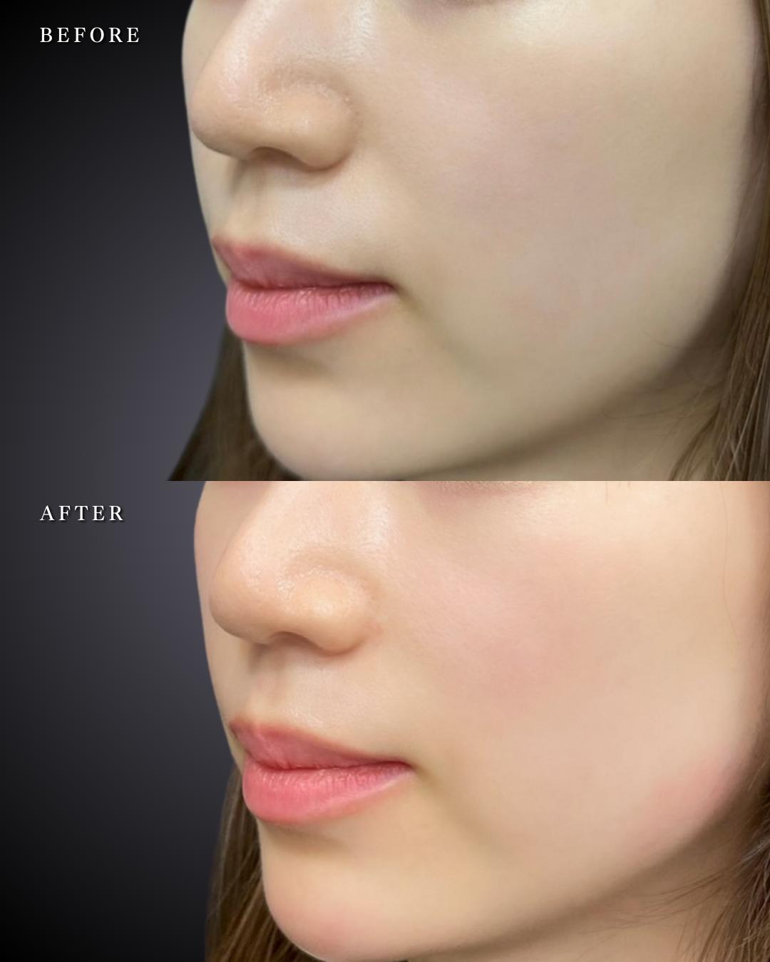 ヒアルロン酸の症例写真