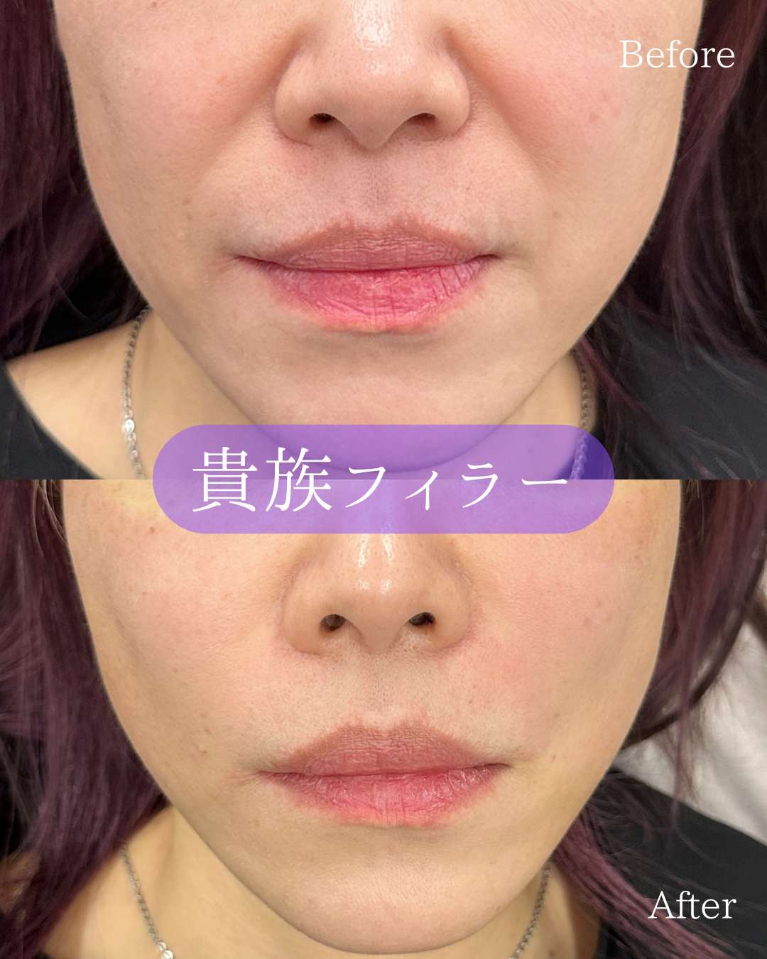 ヒアルロン酸の症例写真