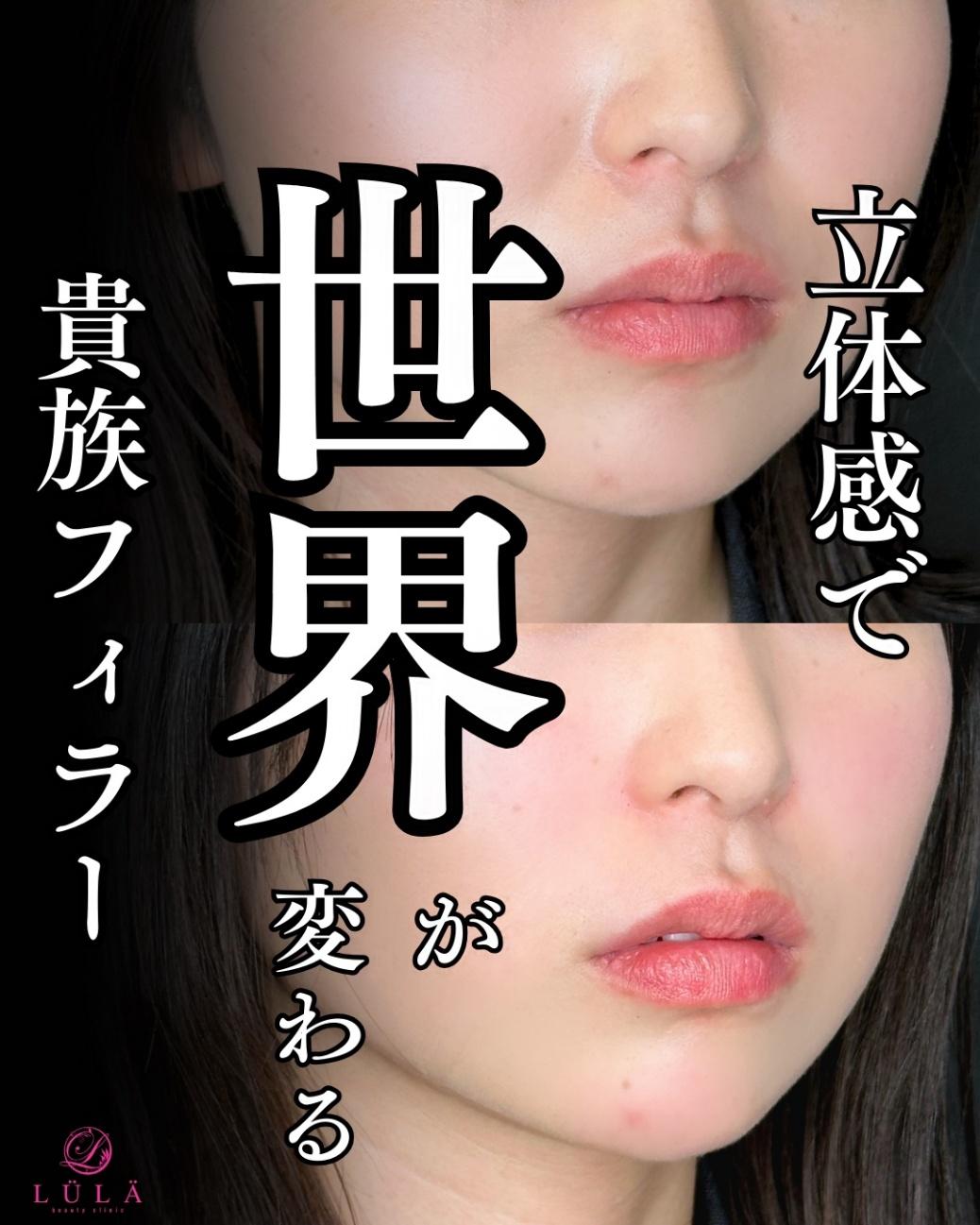 ヒアルロン酸の症例写真