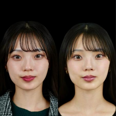 ヒアルロン酸の症例写真
