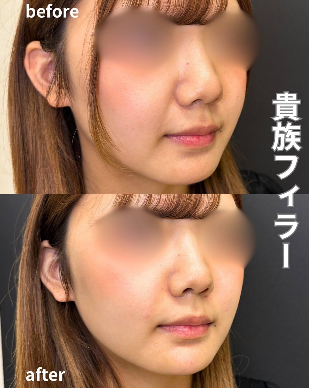 ヒアルロン酸の症例写真