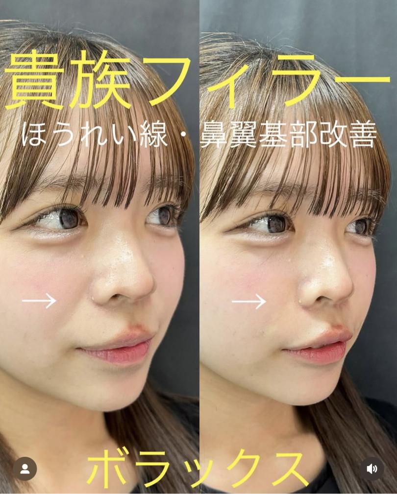 ヒアルロン酸の症例写真