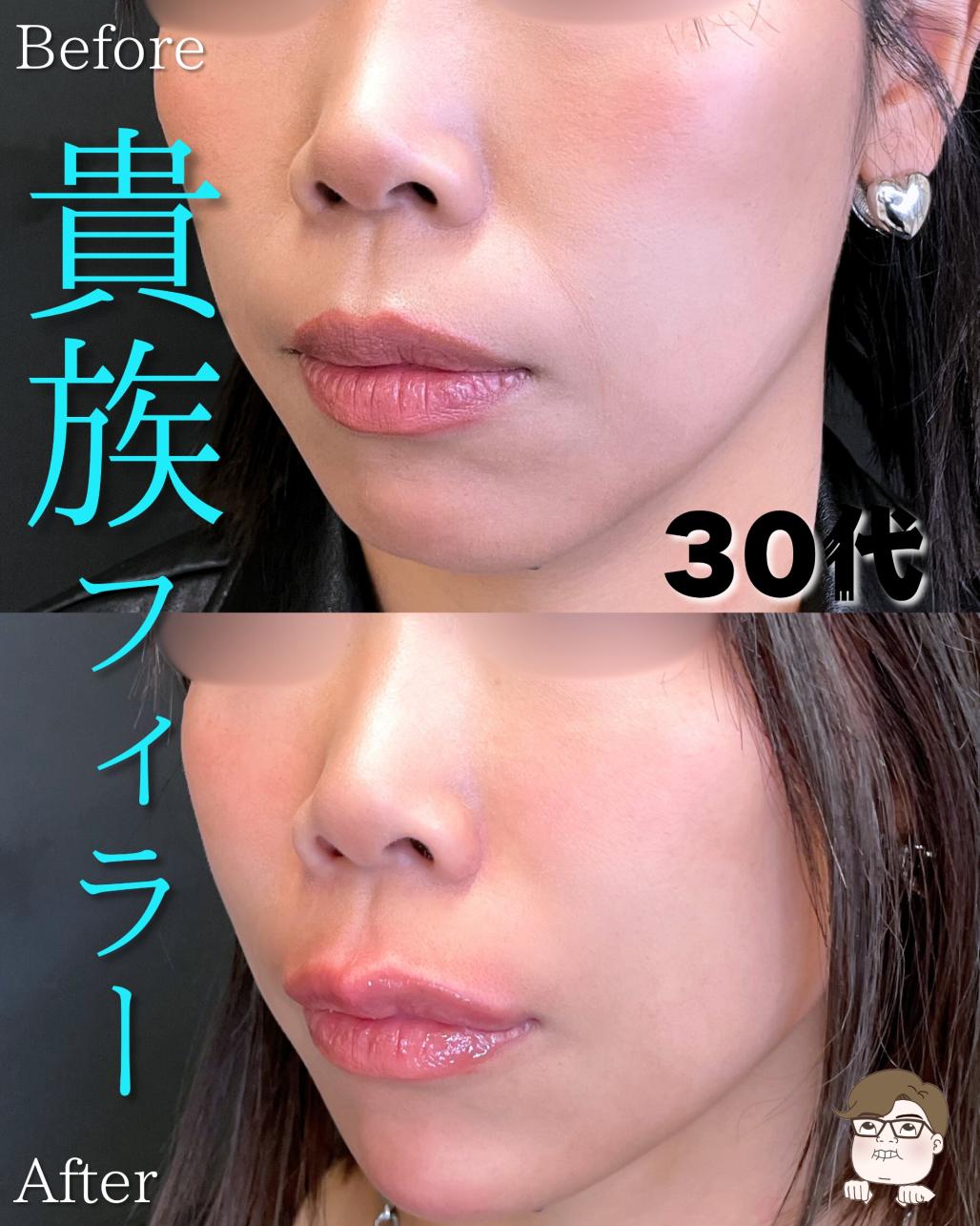 ヒアルロン酸の症例写真