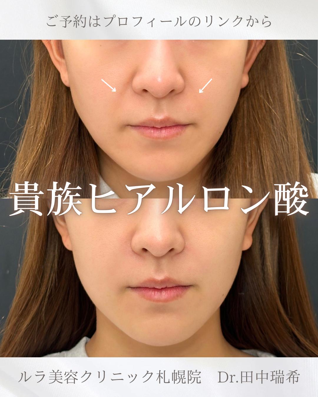 ヒアルロン酸の症例写真