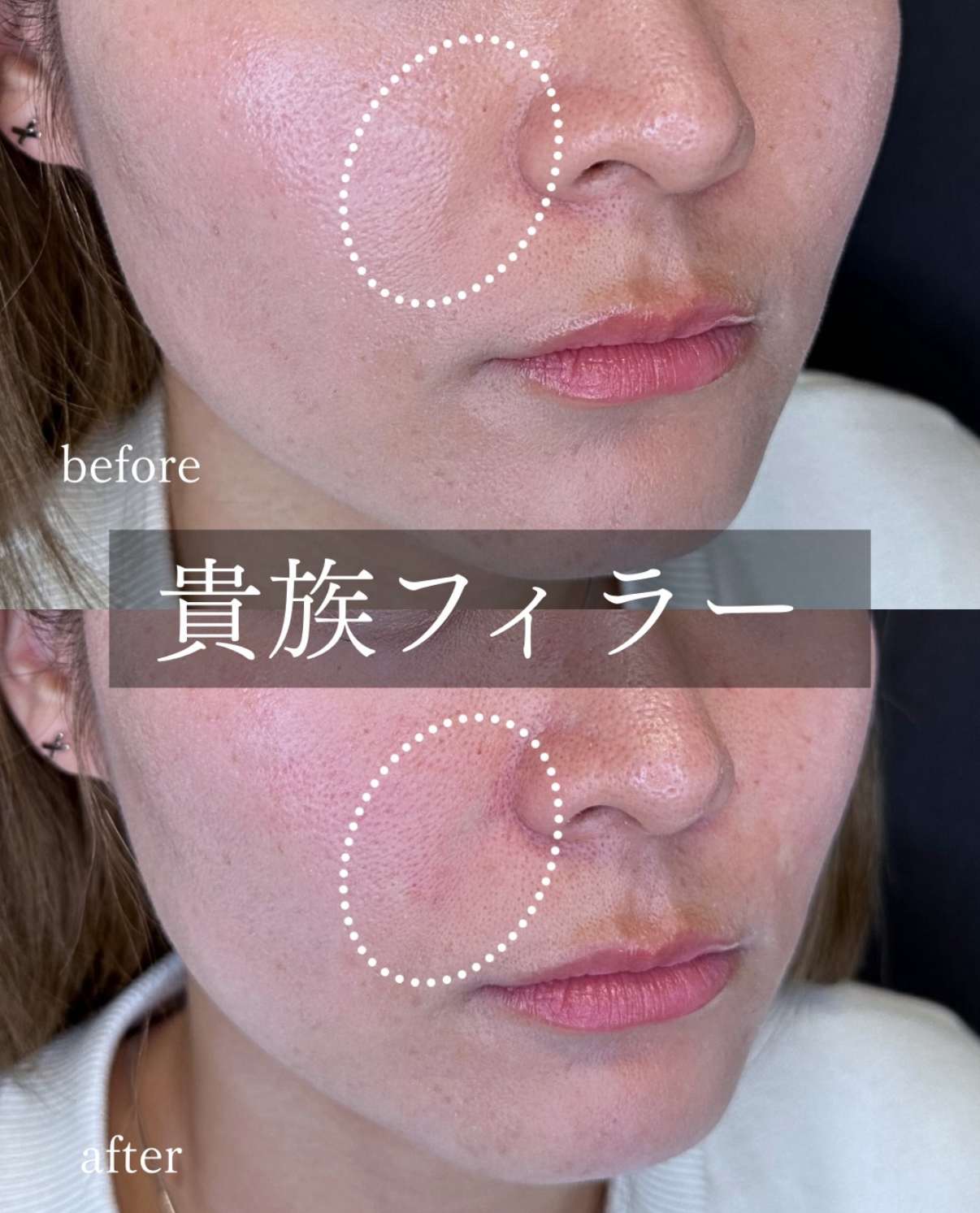 ヒアルロン酸の症例写真