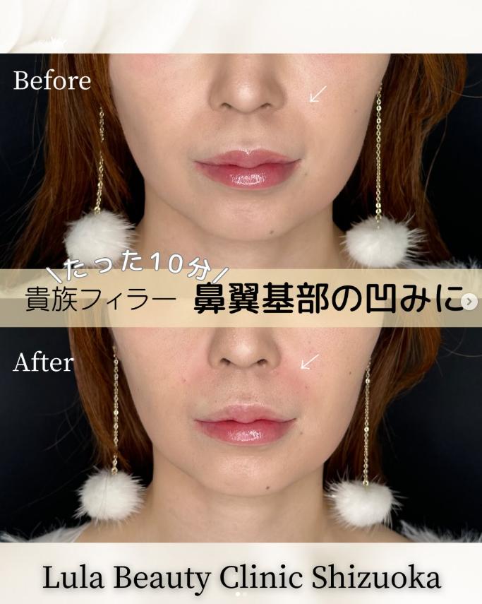 ヒアルロン酸の症例写真