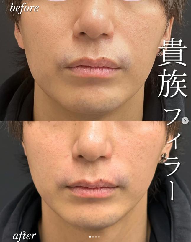 ヒアルロン酸の症例写真