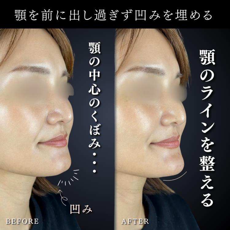 ヒアルロン酸の症例写真