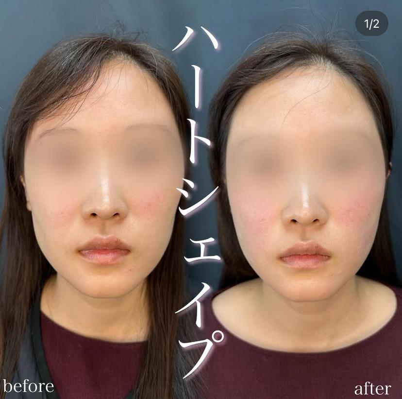 ヒアルロン酸の症例写真