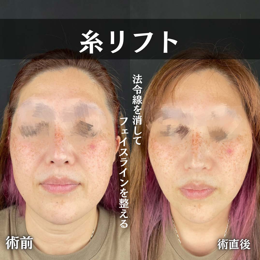 ルラリフトの症例写真