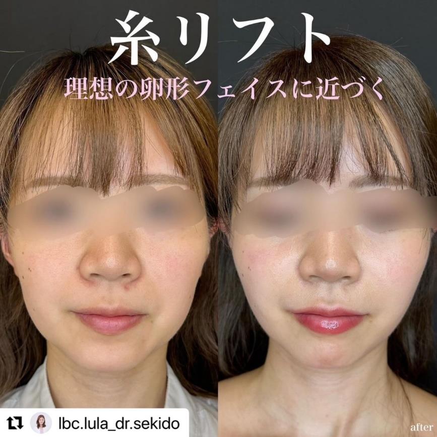 ルラリフトの症例写真