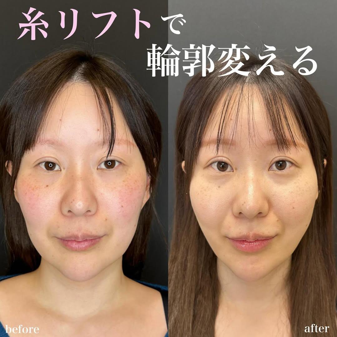ルラリフトの症例写真