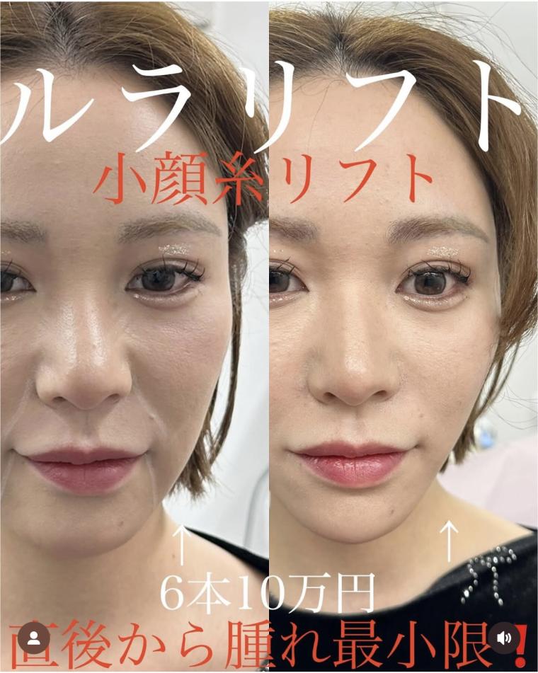 ルラリフトの症例写真