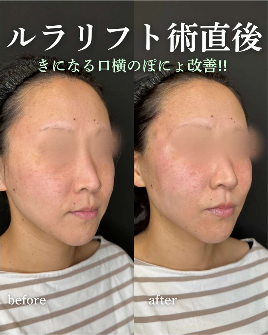 ルラリフトの症例写真