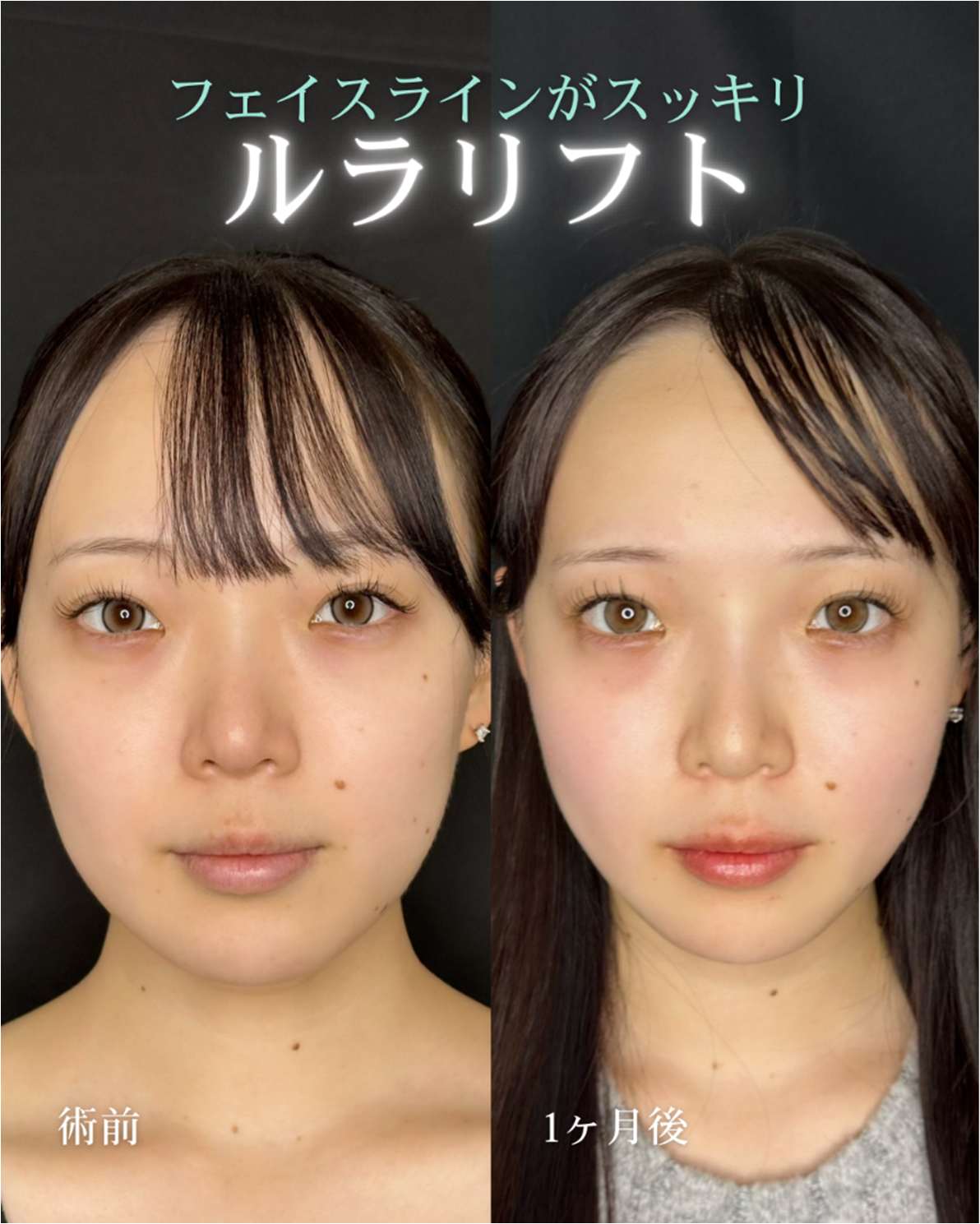 ルラリフトの症例写真