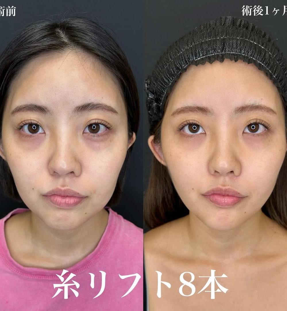 ルラリフトの症例写真