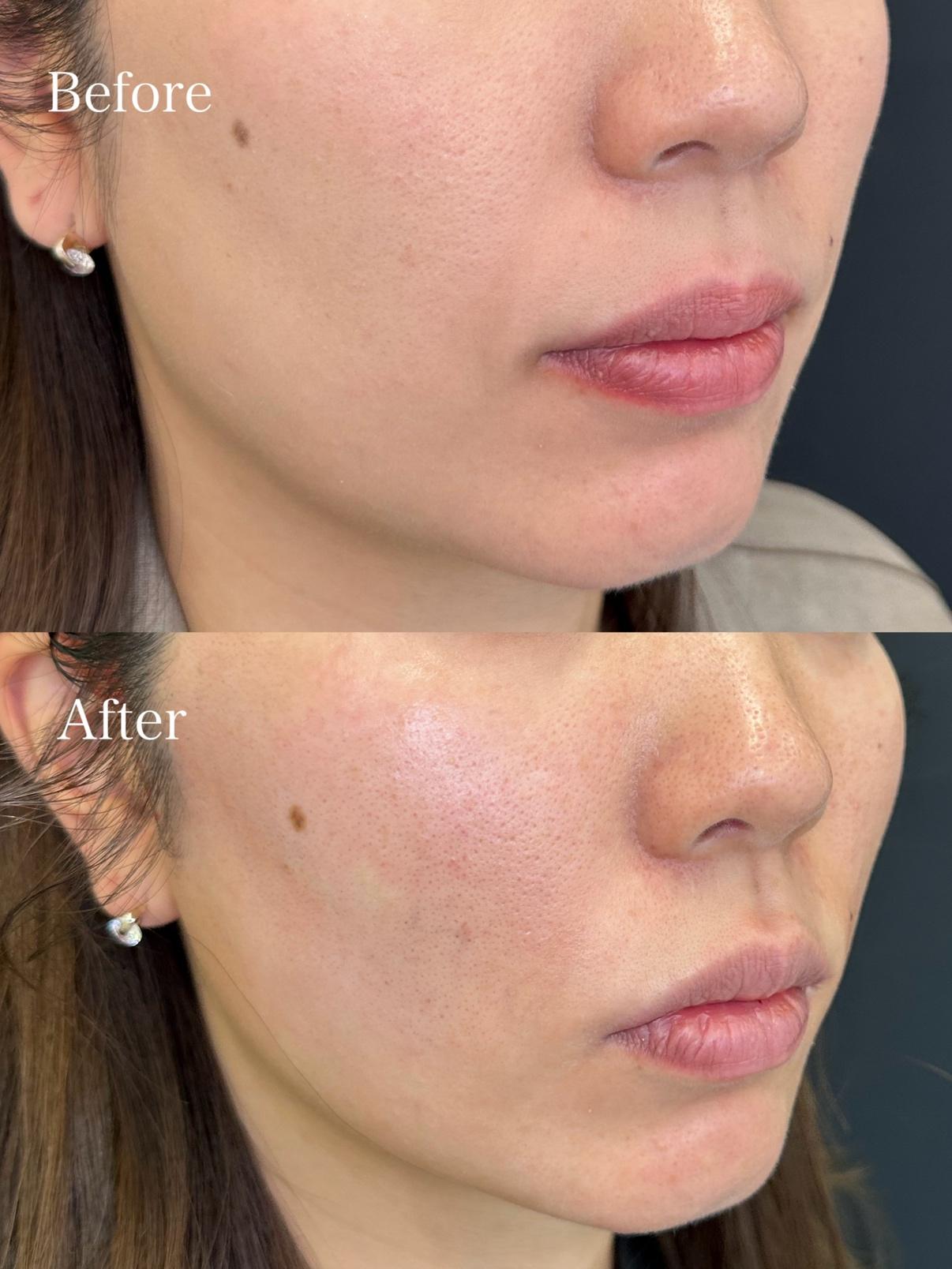 ルラリフトの症例写真