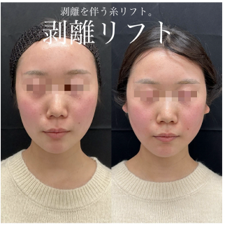 ルラリフトの症例写真