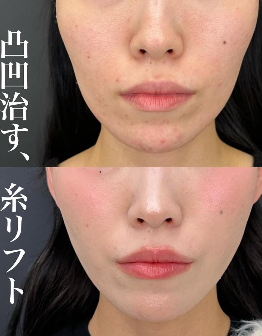 ルラリフトの症例写真