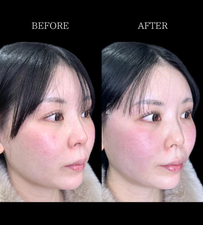 ルラリフトの症例写真