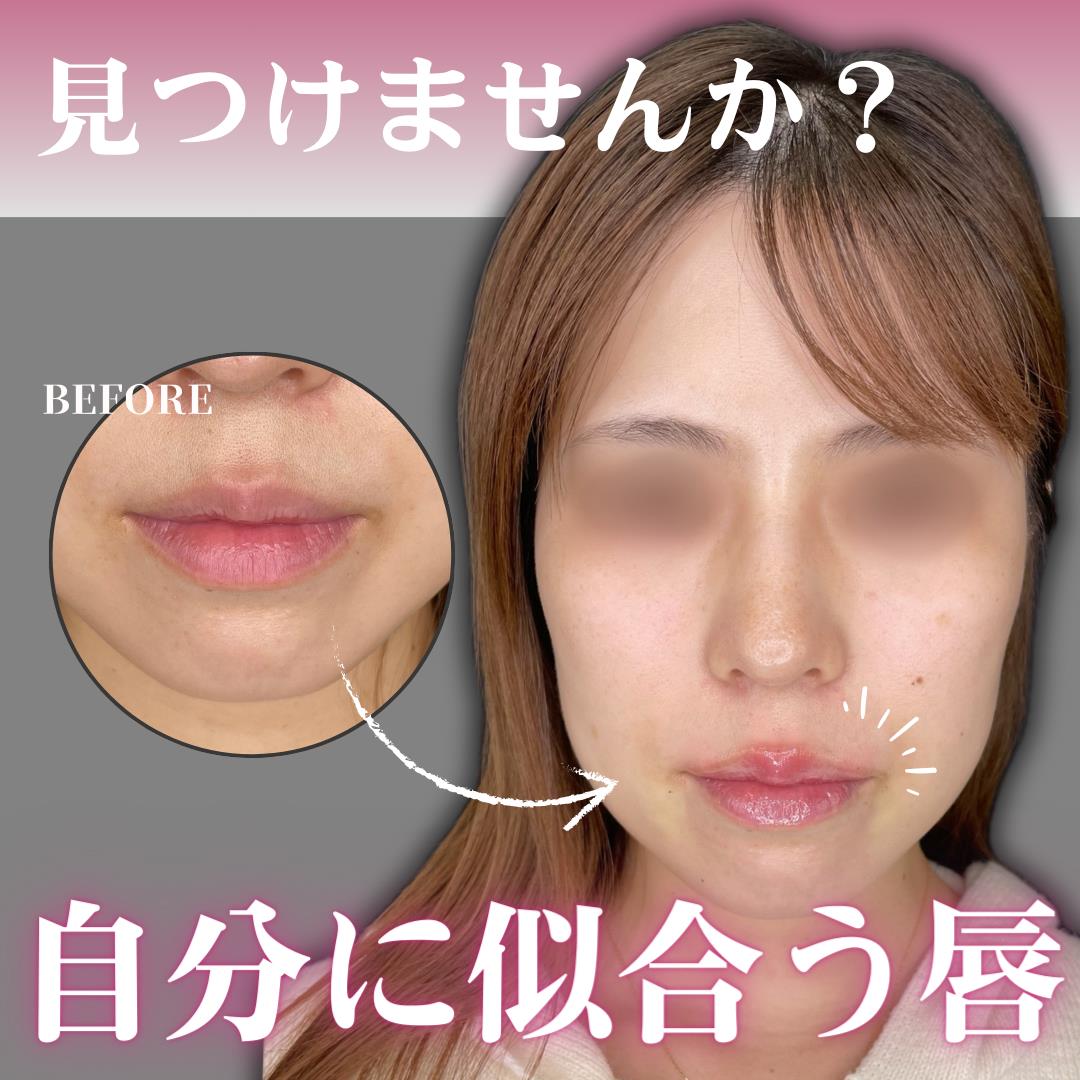 スマイルリップの症例写真