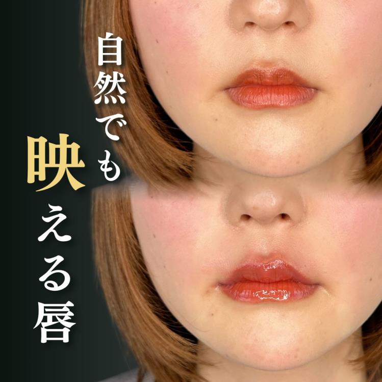 スマイルリップの症例写真