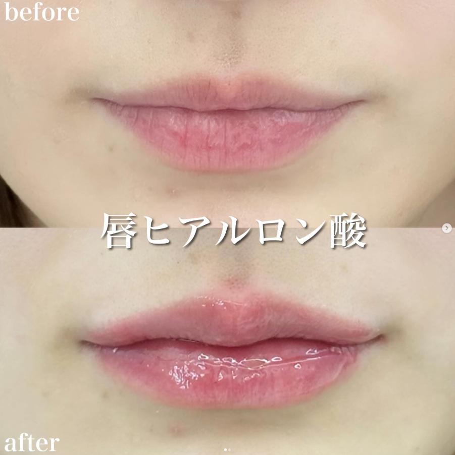 Cカールリップの症例写真