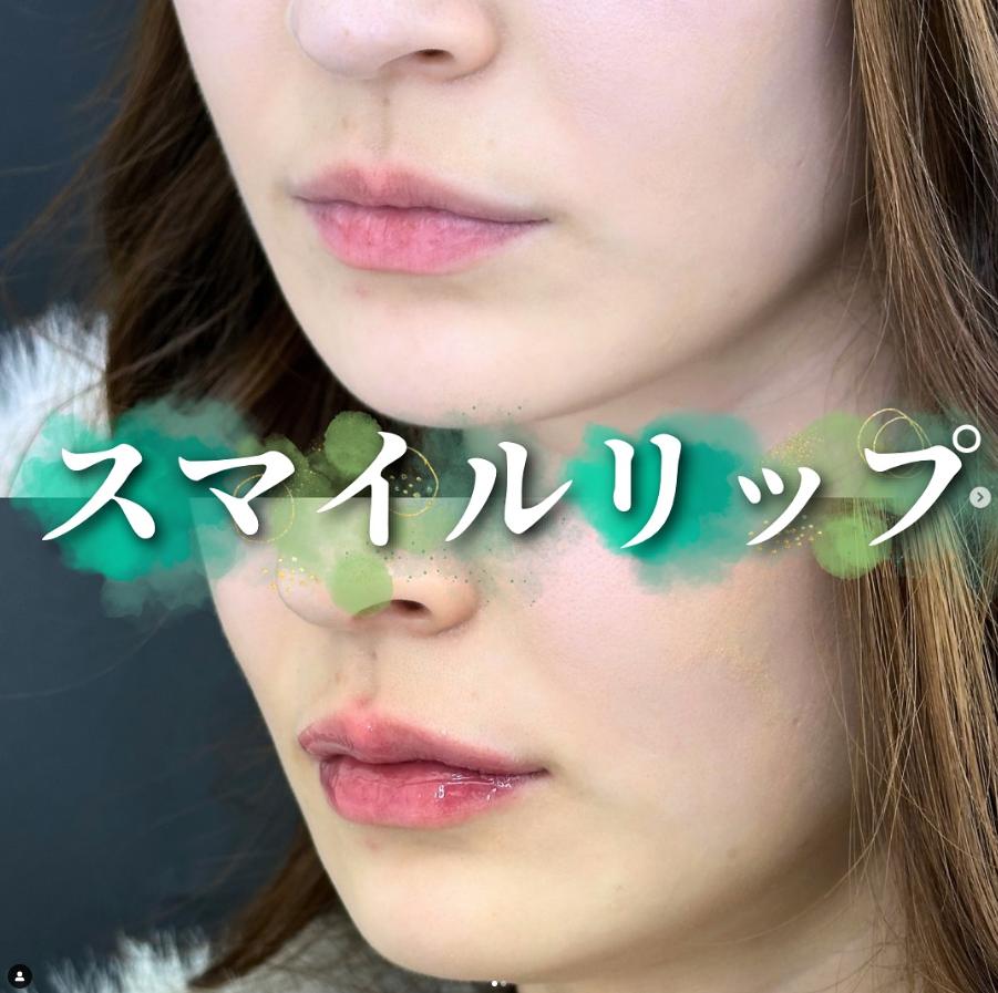 Cカールリップの症例写真