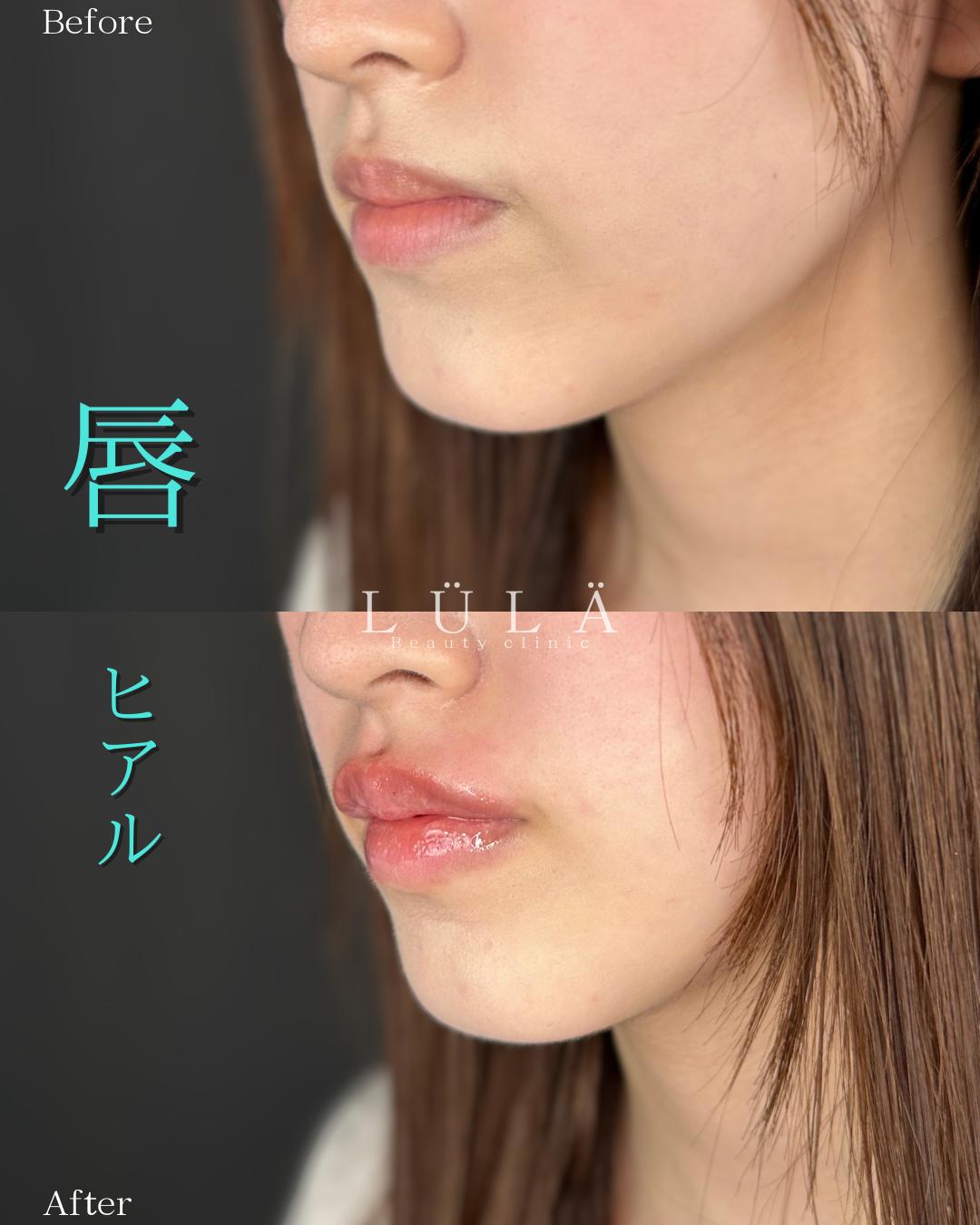 Cカールリップの症例写真