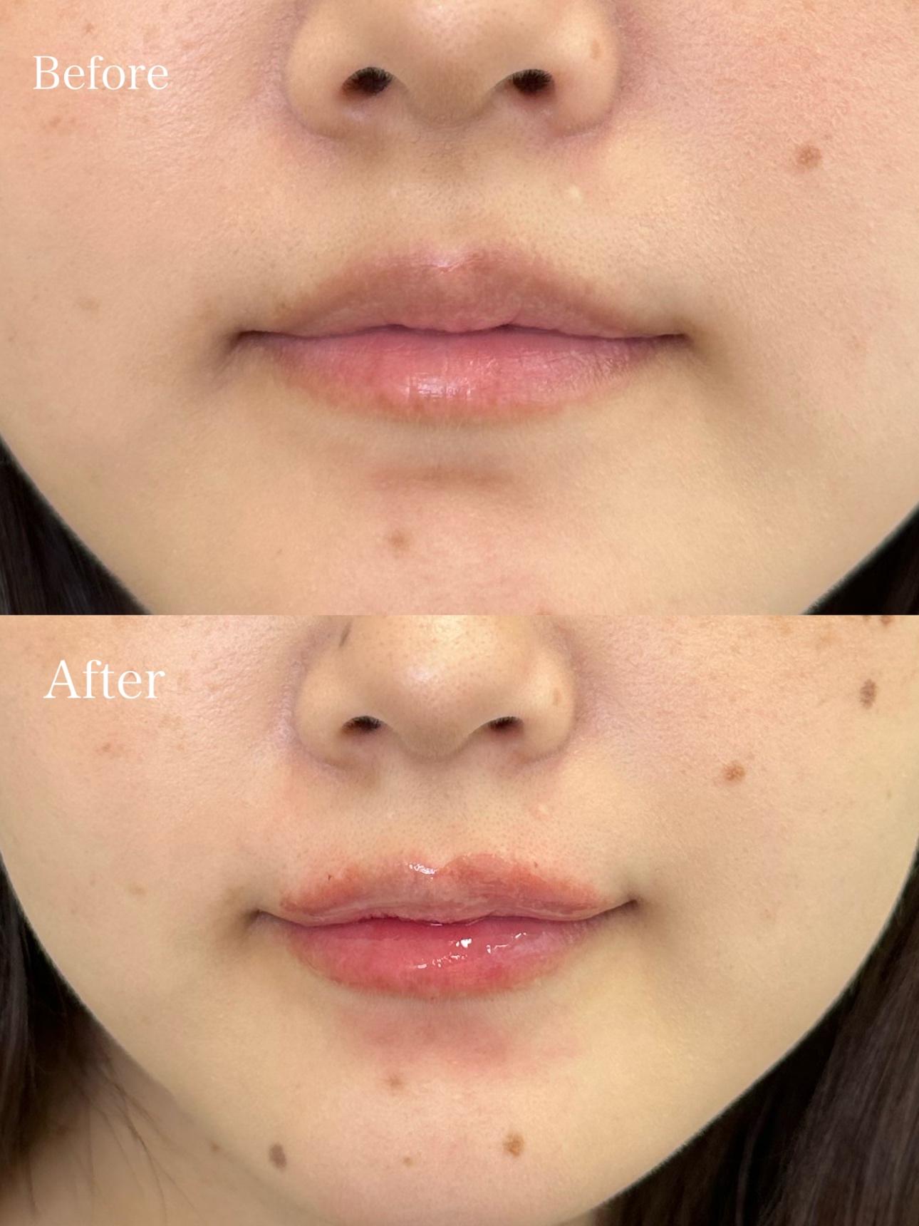 Cカールリップの症例写真