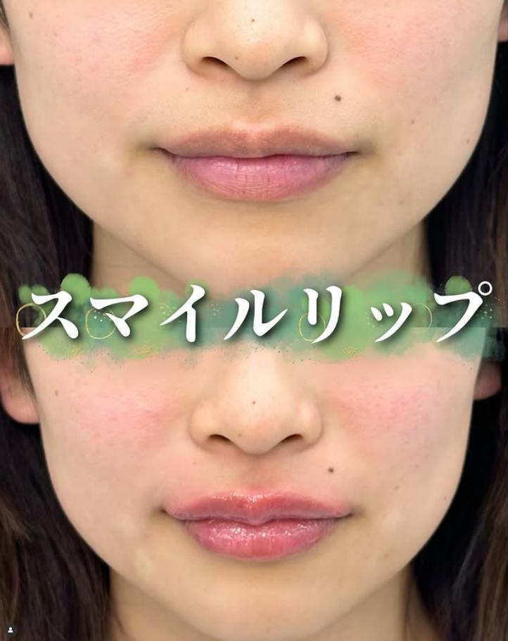 Cカールリップの症例写真