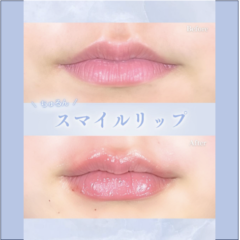 Cカールリップの症例写真