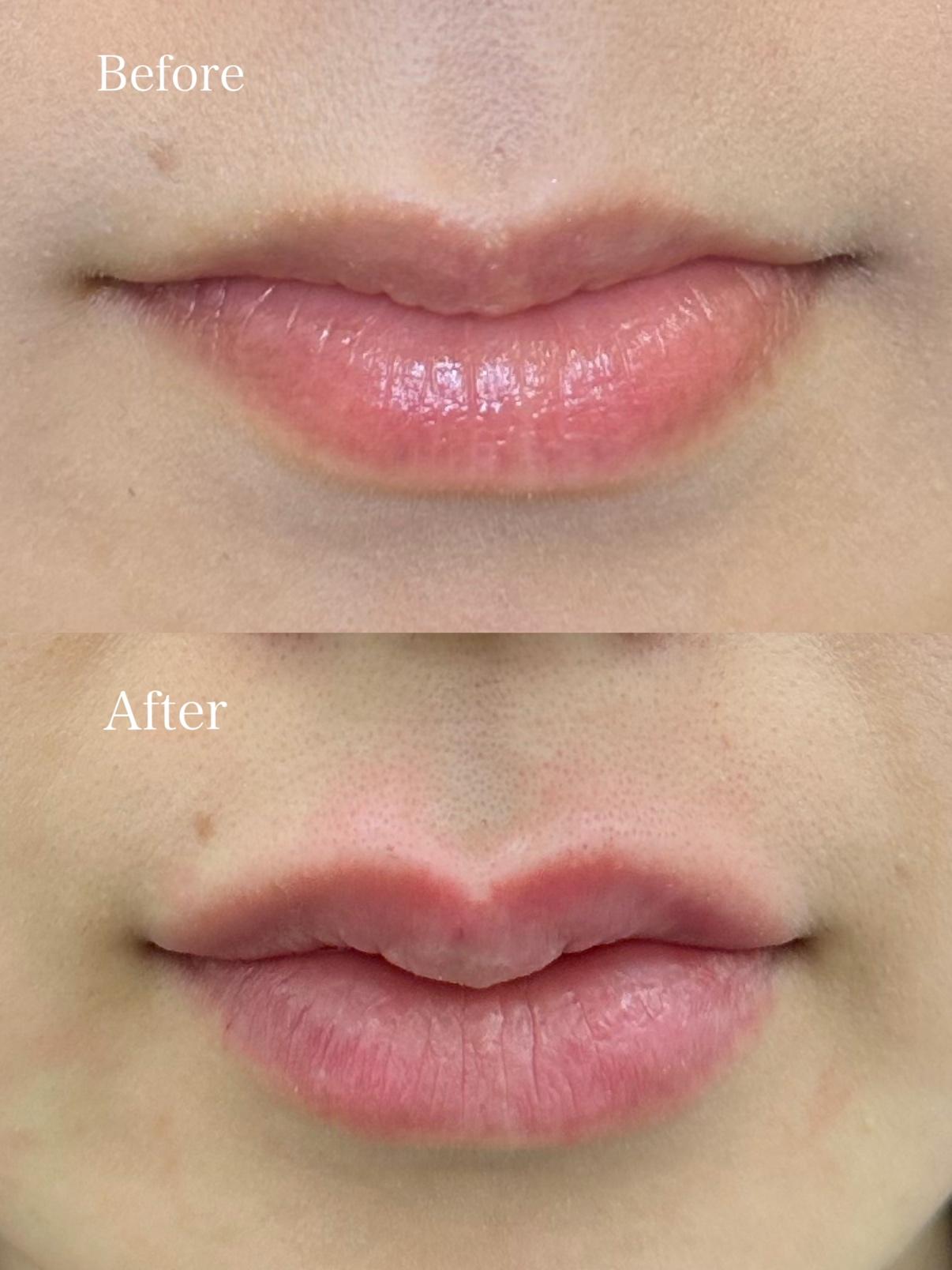 Cカールリップの症例写真