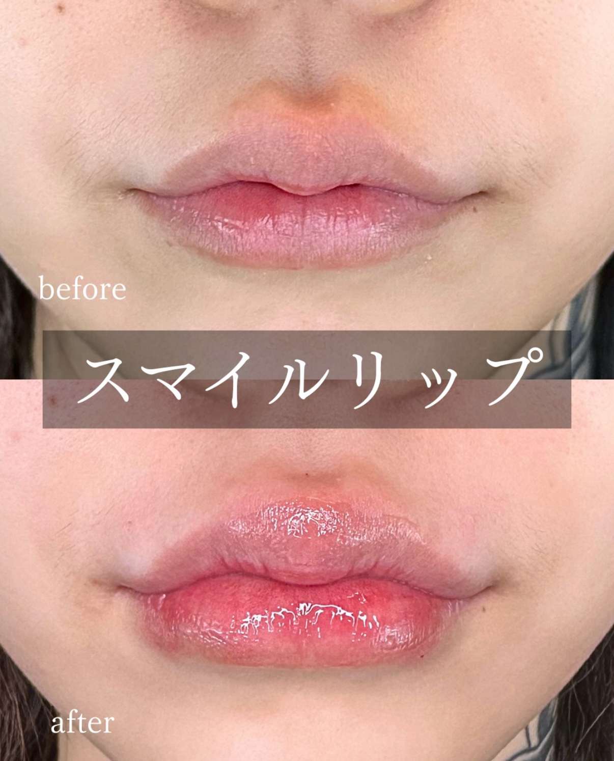 Cカールリップの症例写真