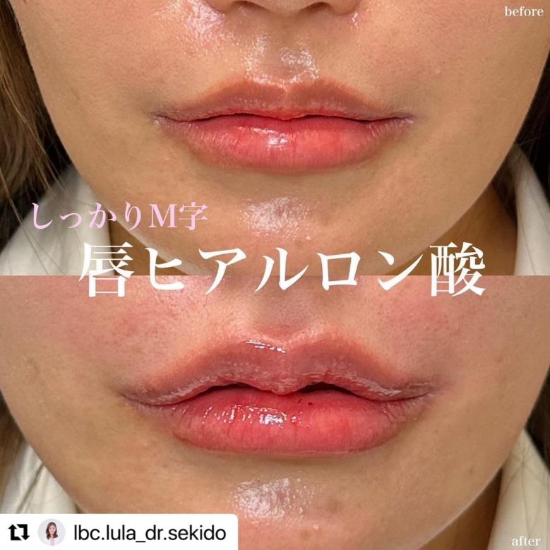 Cカールリップの症例写真